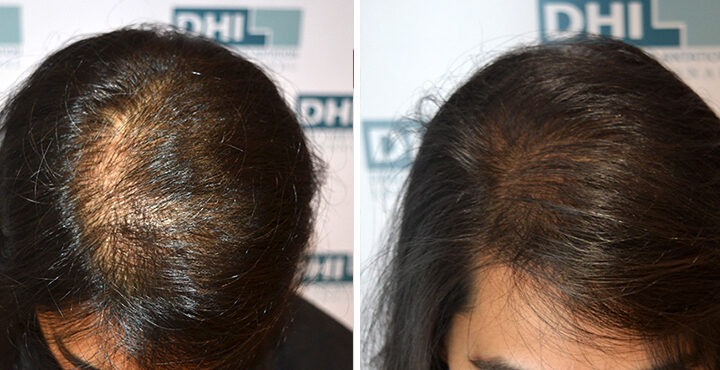 best hair transplant in lahore