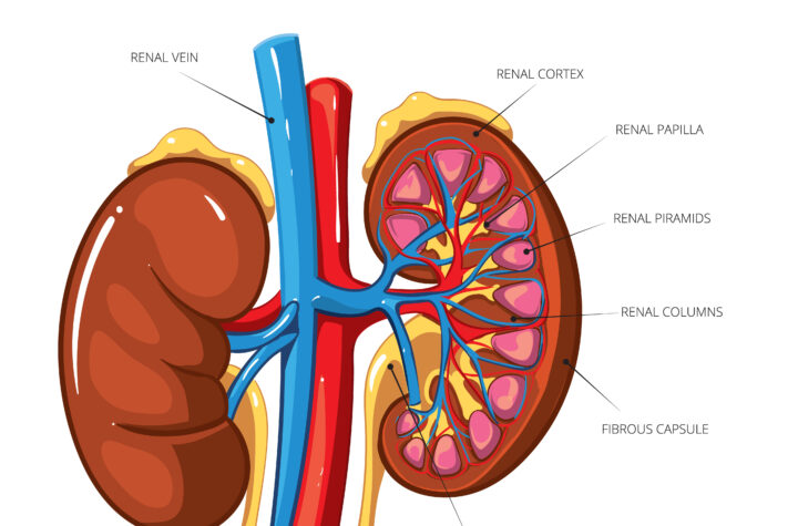 Kidney Stone