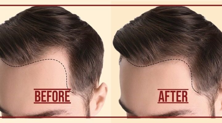 Hair Transplant Service NY New Hyde Park