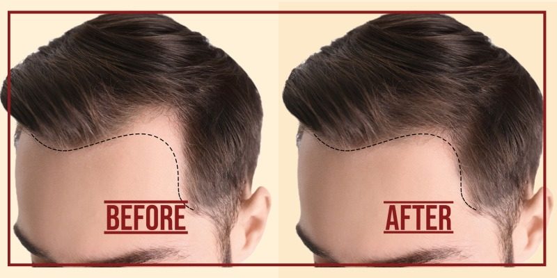 Hair Transplant Service NY New Hyde Park