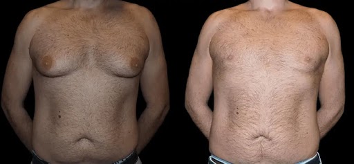 Before and after male breast reduction results