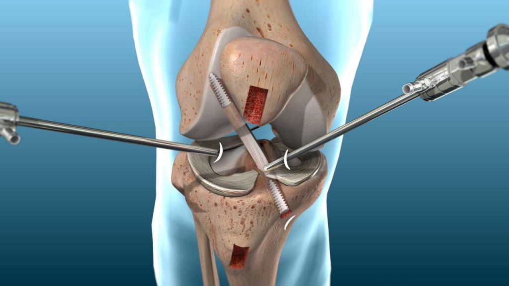 best acl surgeon in hisar