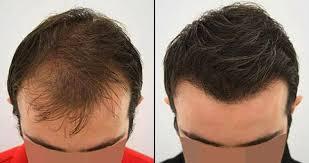 hair transplant in lahore