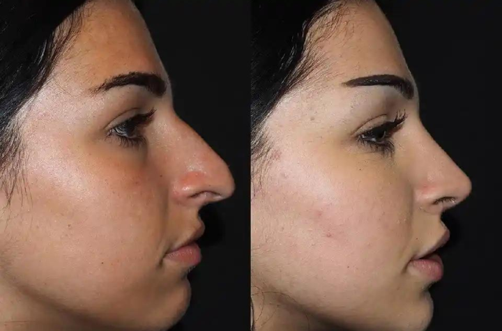 Rhinoplasty in Dubai: When Can I Drive Again?