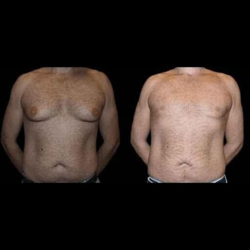 Before and After Male Breast Reduction REsults