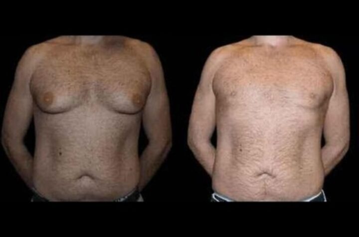 Before and After Male Breast Reduction REsults