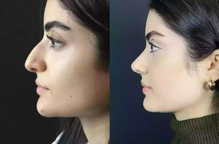 What is Ethnic Rhinoplasty in Dubai?