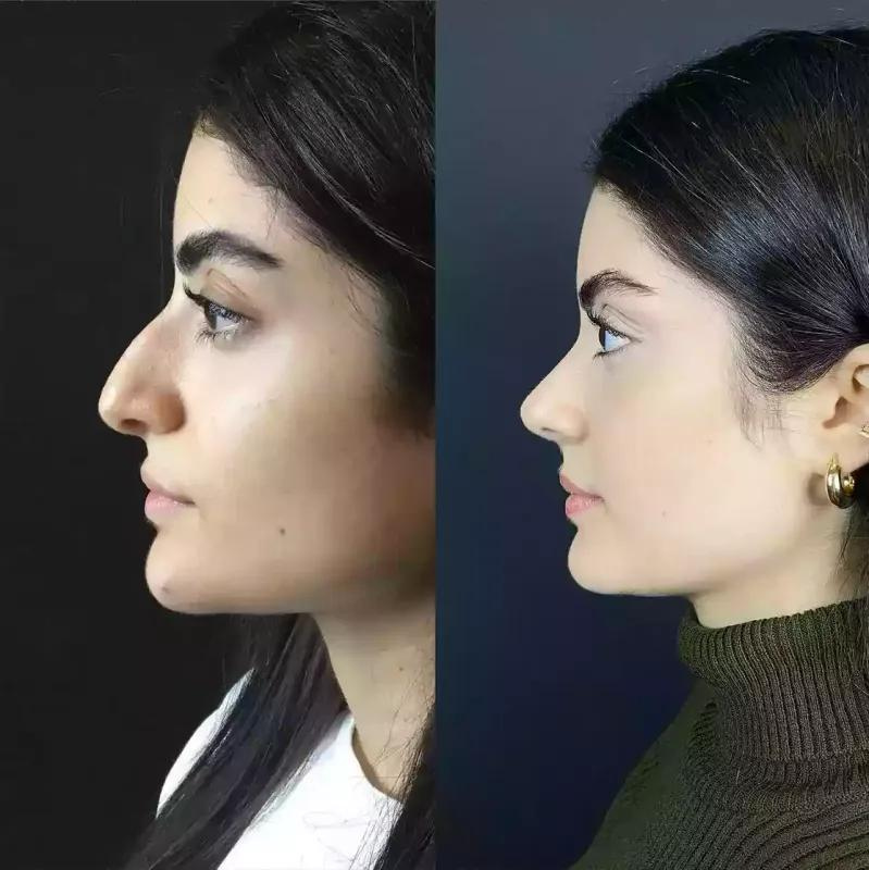 What is Ethnic Rhinoplasty in Dubai?