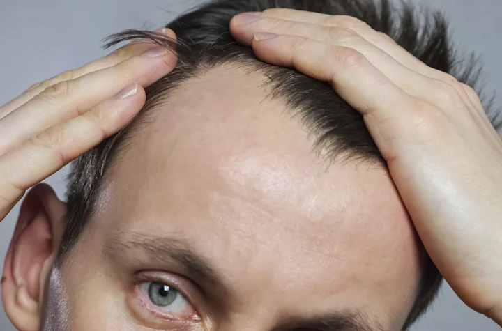 Hair transplant in Islamabad