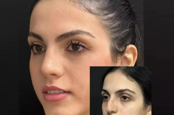 Nose Surgery in Dubai: Costs, Benefits, and Recovery Insights