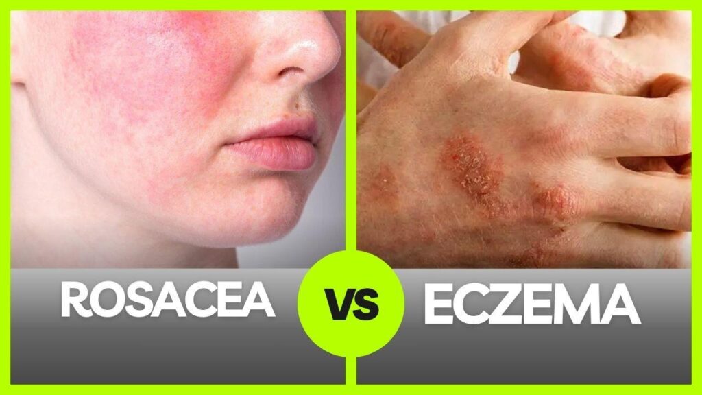 rosacea vs eczema